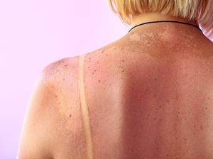 sonnenbrand und pigmentflecken auf der haut